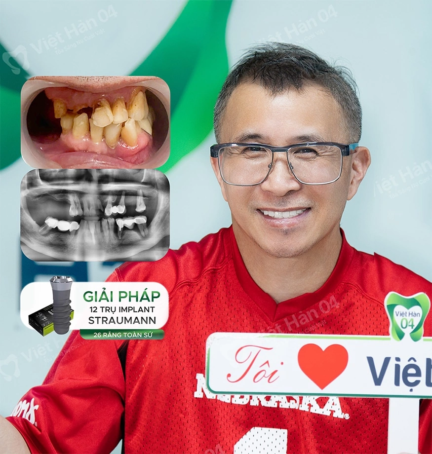 Trồng răng Implant