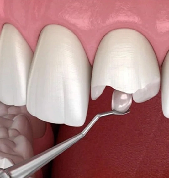 Trám răng thẩm mỹ