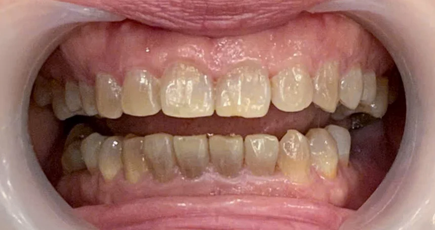 Răng bị ố vàng,<br>nhiễm màu nặng
