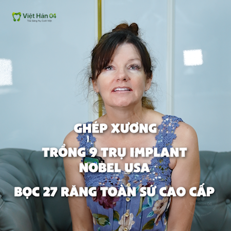 Chị K.Linda phục hình 9 trụ Implant, lấy lại nụ cười tự tin sau 25 năm mất nhiều răng