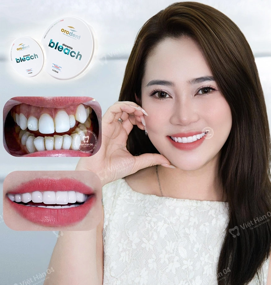 Răng sứ thẩm mỹ