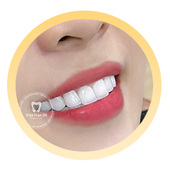 Bước 5