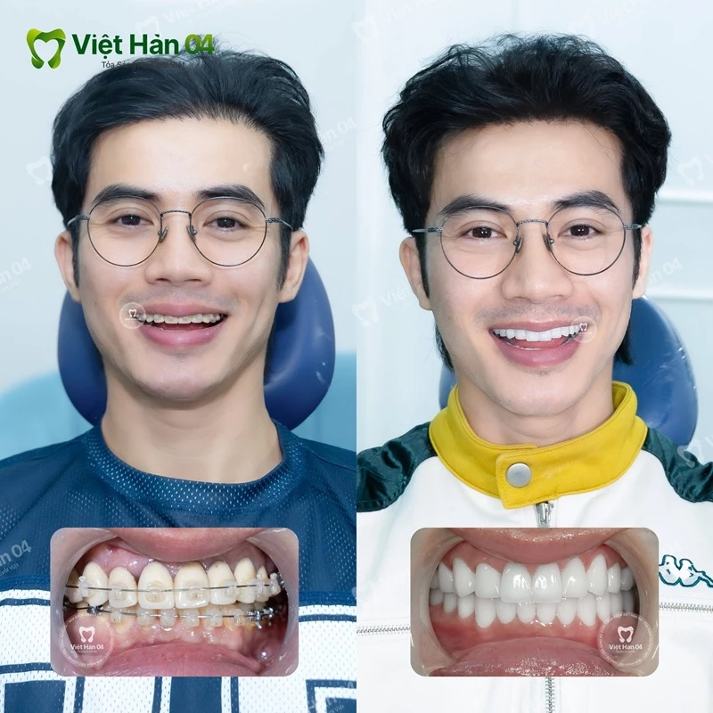 Kiến tạo nụ cười đẹp tự nhiên, đậm chất riêng cho nam thần màn ảnh Malaysia