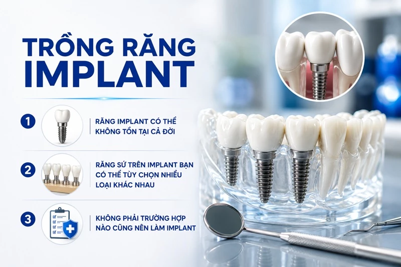 3 sự thật về trồng răng implant bạn nên biết 
