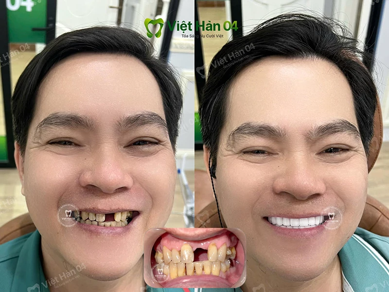 Mất răng gây mất thẩm mỹ khuôn mặt