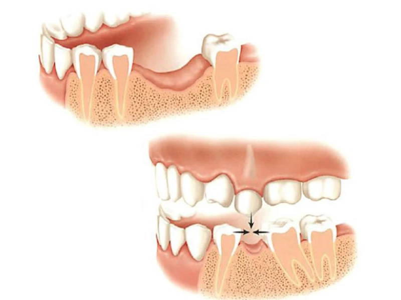 Hàm răng xô lệch, sai khớp cắn