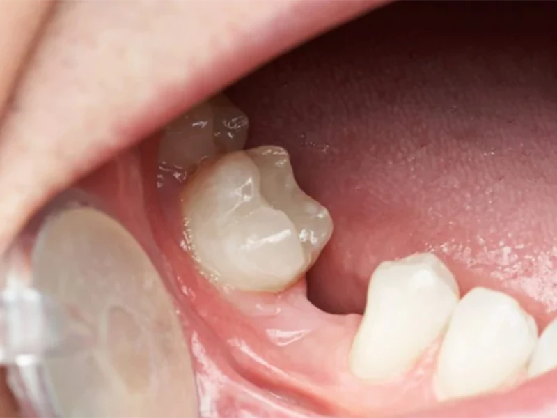 Khoảng trống răng bị mất quá hẹp