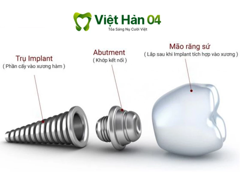 Abutment Implant 