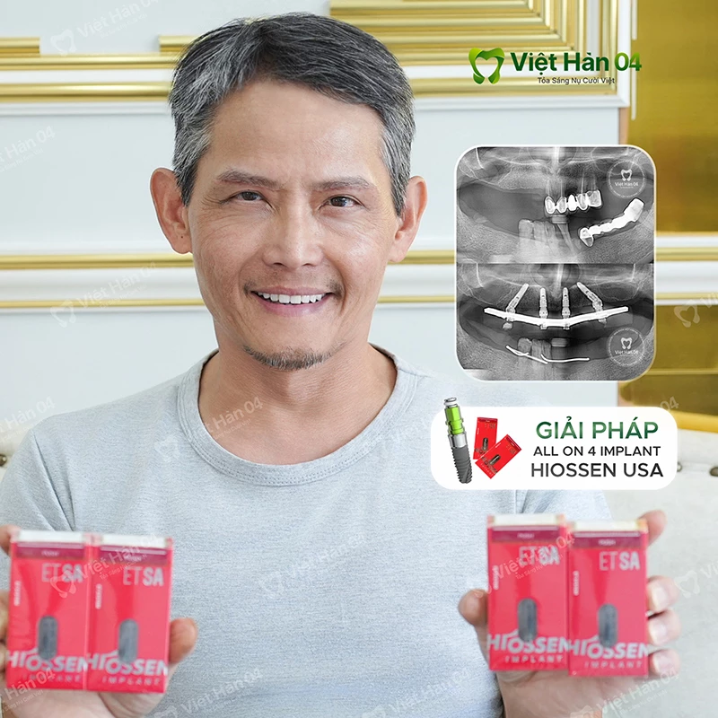 All On 4 Implant Hiossen USA