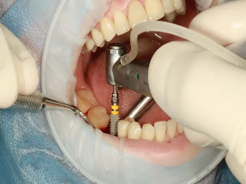 Bác sĩ giàu kinh nghiệm có vai trò quan trọng trong thực hiện cấy ghép Implant 