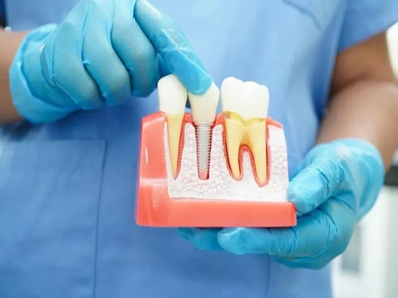 Bác sĩ nha khoa giàu kinh nghiệm thực hiện cấy ghép implant an toàn, uy tín 