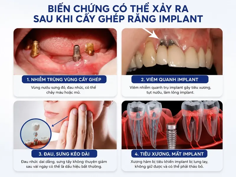 Biến chứng có thể xảy ra sau khi cấy ghép răng implant 