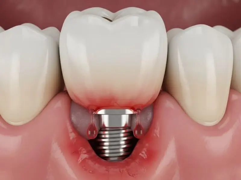 Biến chứng nhiễm trùng sau cấy ghép Implant