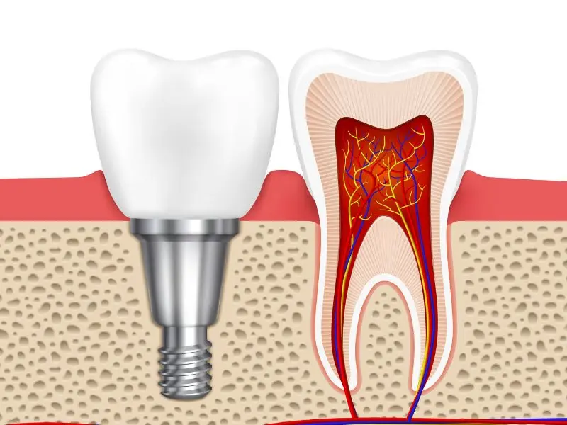 Biến chứng tổn thương dây thần kinh và mô mềm xung quanh 