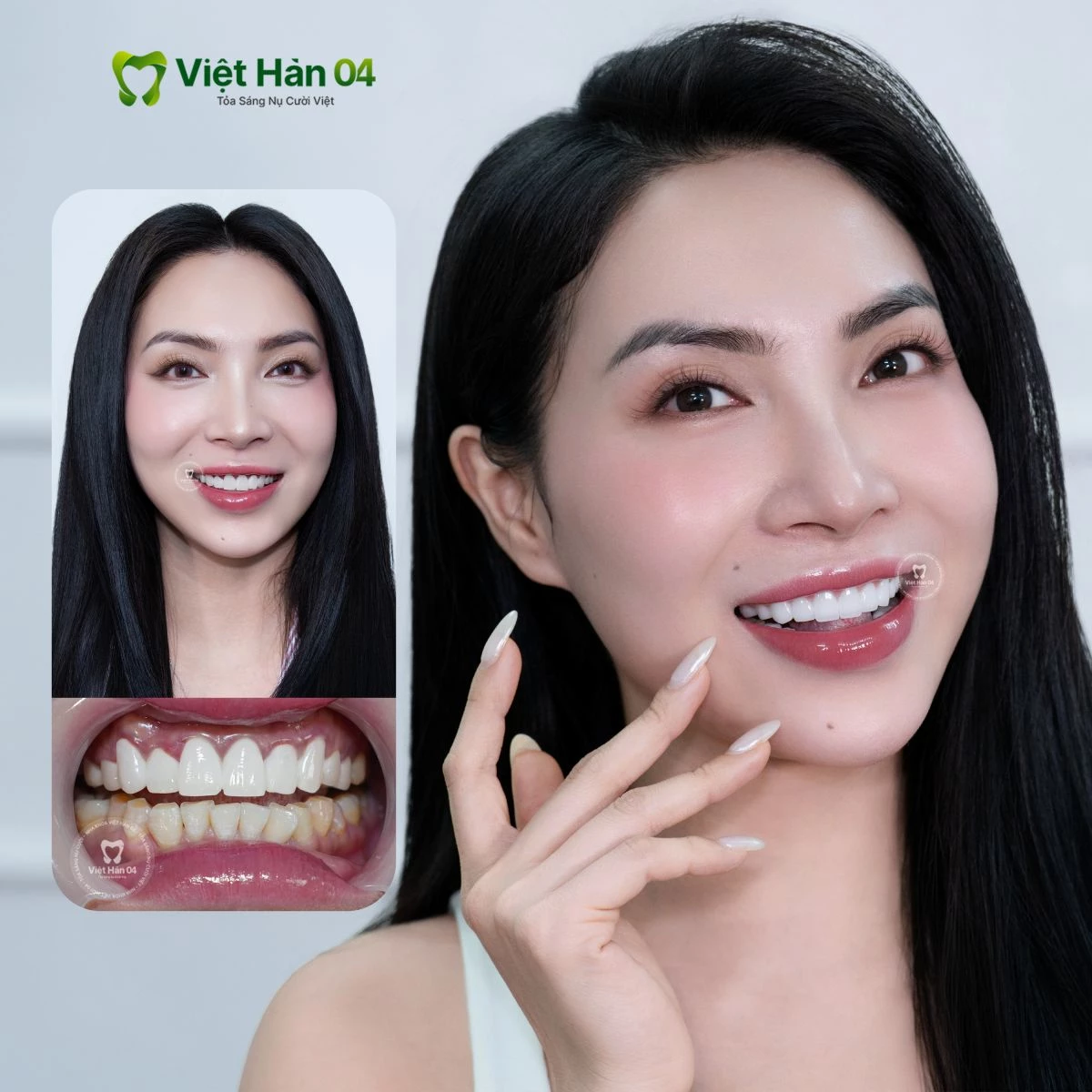Tiktoker Trish Phan: Bọc 16 răng sứ Orodent Bleach 