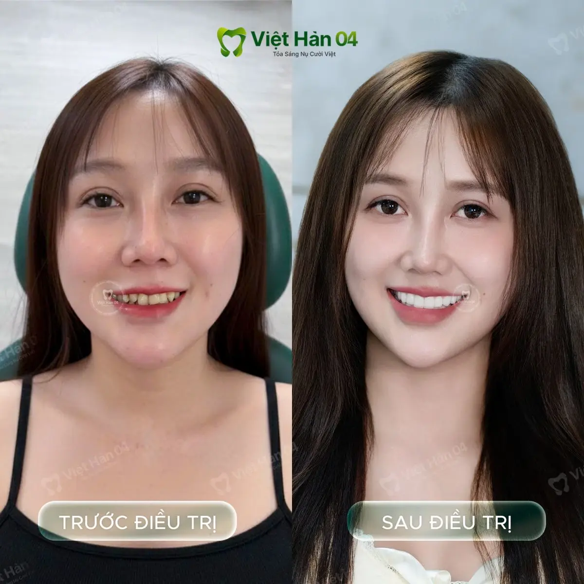 Khách hàng Minh Châu - Bọc 17 răng sứ Lava Plus tại Nha khoa Việt Hàn 04
