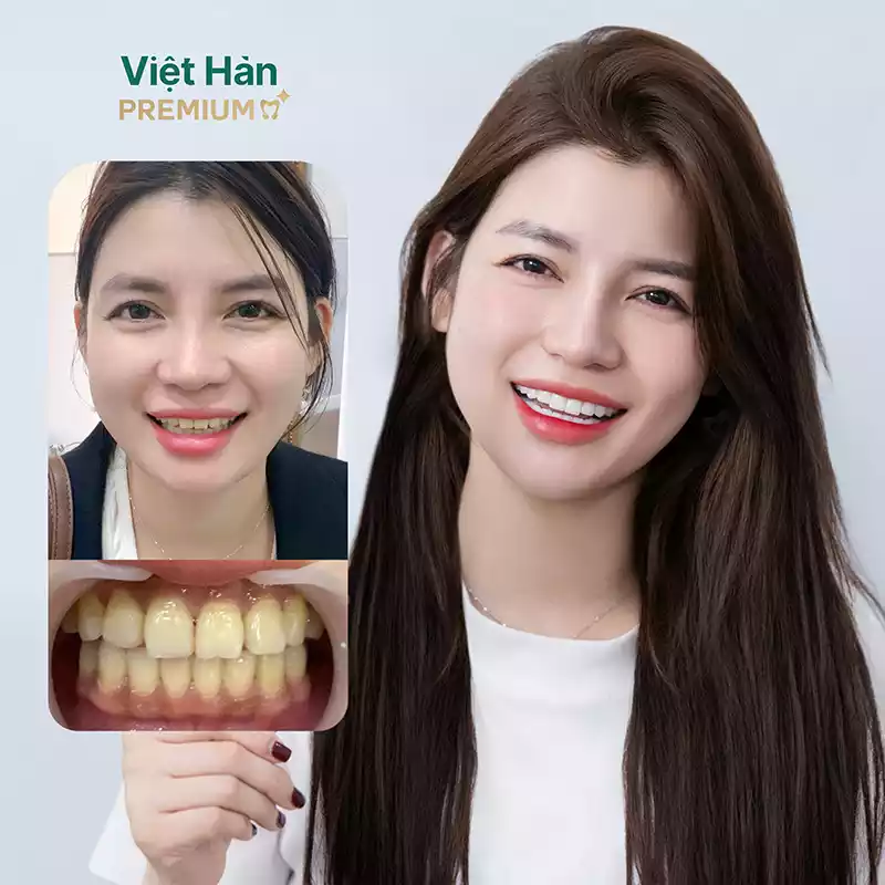 Hình ảnh khách hàng nữ bọc 2 hàm răng sứ 
