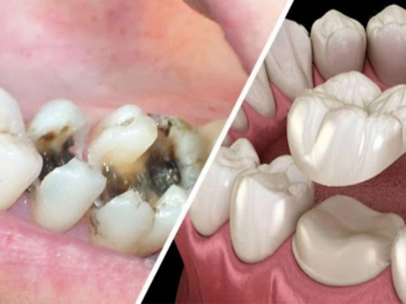 Hình ảnh răng sứ bị sâu