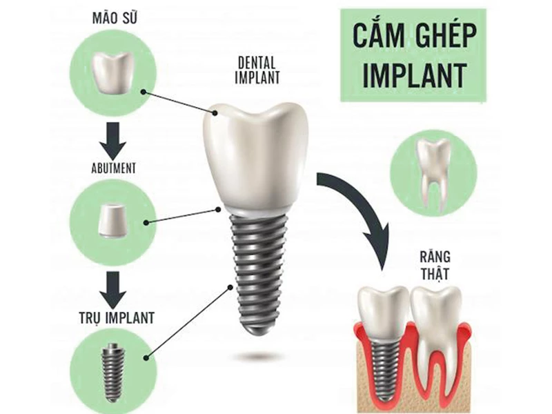 cấu tạo của trụ implant 
