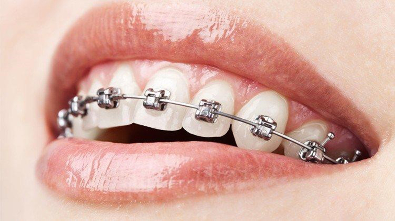 Niềng răng mắc cài mỹ