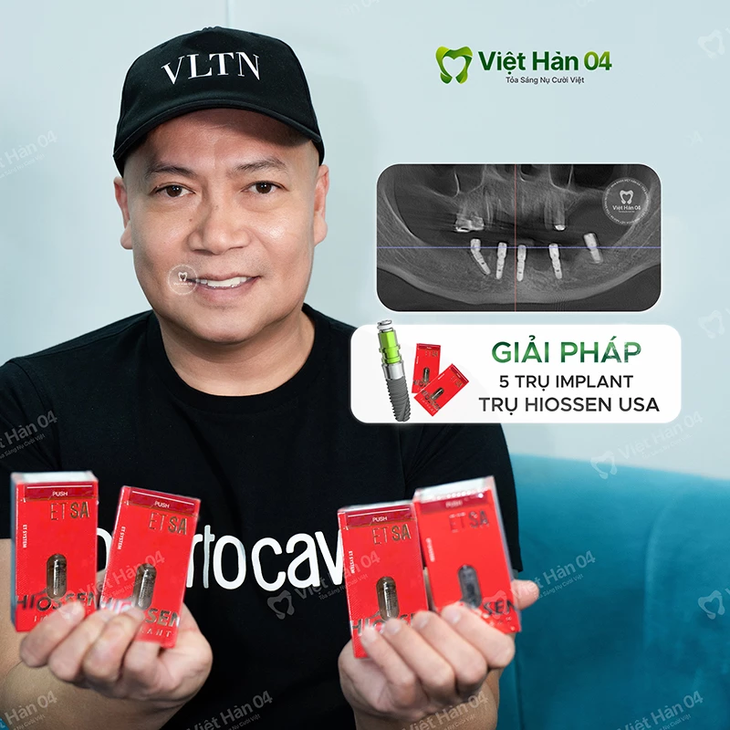 Cắm Implant 5 trụ Hiossen USA