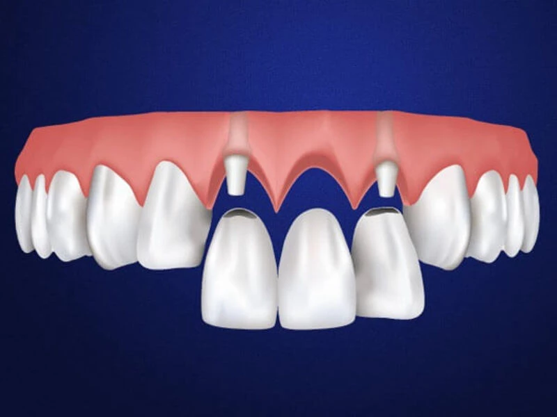 Cầu răng sứ phục hồi răng đã mất 