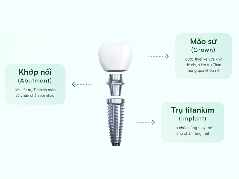 Cấu tạo trụ Implant
