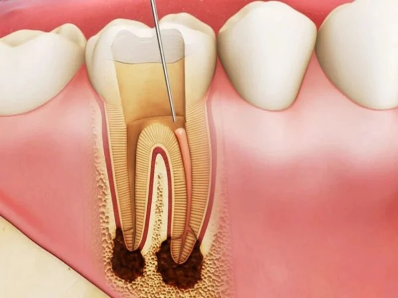 Cấu trúc răng số 7 bị vi khuẩn sâu răng xâm nhập gây tổn thương viêm tủy 
