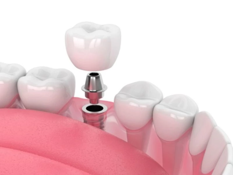 Cấy ghép implant có thể bền vững cả đời