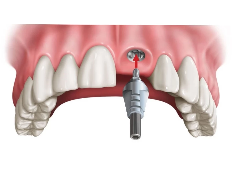 Cấy ghép implant đơn lẻ