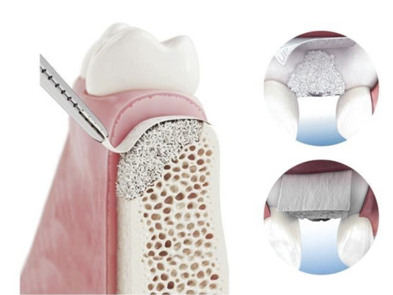 Ghép màng xương trong cấy ghép răng implant