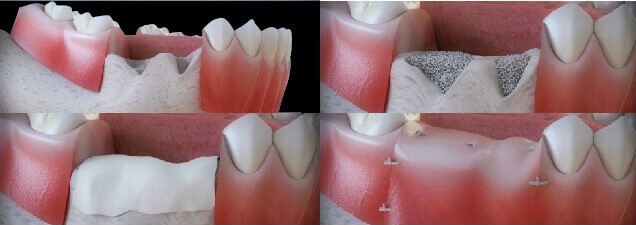Những tình trạng nên cấy ghép implant