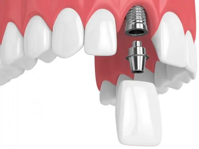 Cấy ghép Implant khắc phục triệt để tình trạng mất chân răng khi răng cửa bị gãy nặng 