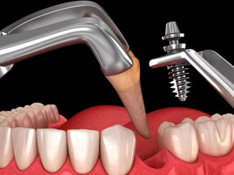 Cấy ghép implant không cần mài các răng bên cạnh
