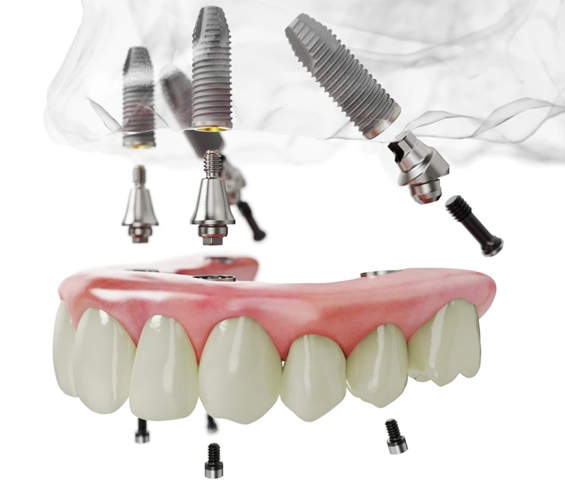Cấy ghép Implant là giải pháp trồng răng nguyên hàm tốt nhất hiện nay 