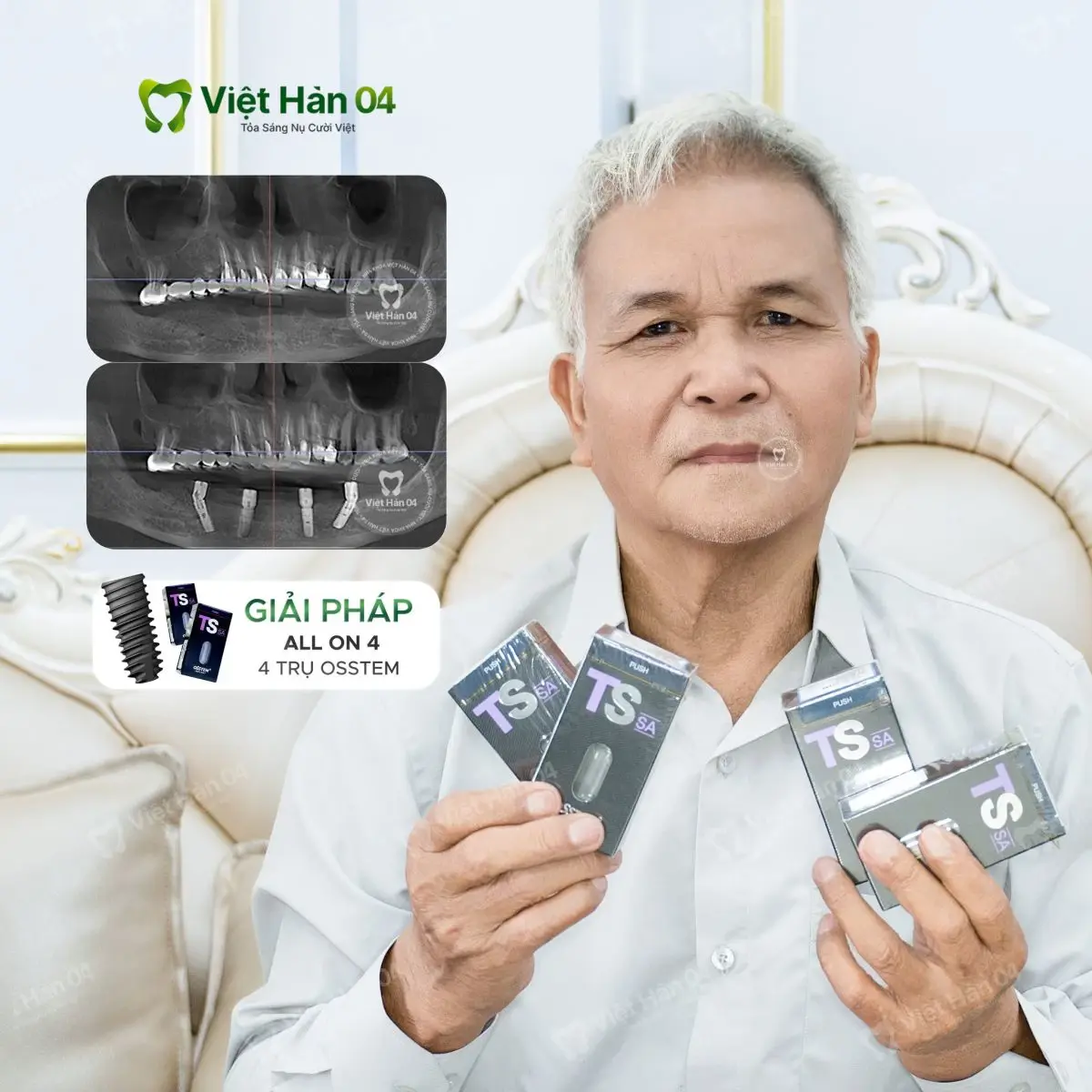 Khách hàng Văn Thiện - Cấy Implant toàn hàm All On 4 với 4 trụ Implant Osstem