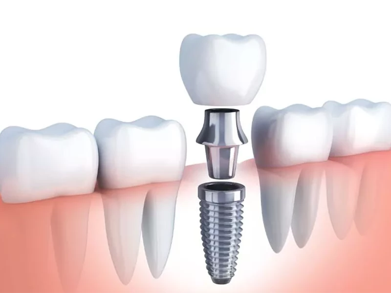 Hình ảnh cấy ghép Implant