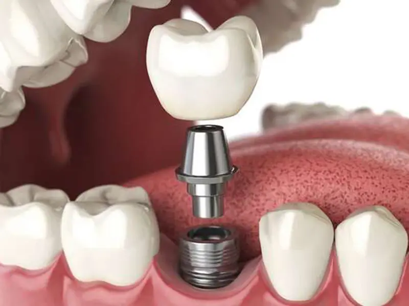 Cấy ghép răng Implant