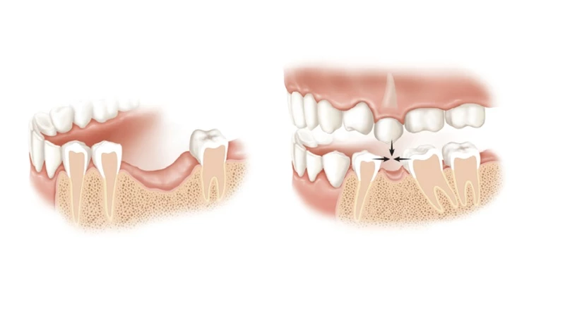 Chất lượng xương hàm của bệnh nhân ảnh hưởng đến thời gian trồng răng implant
