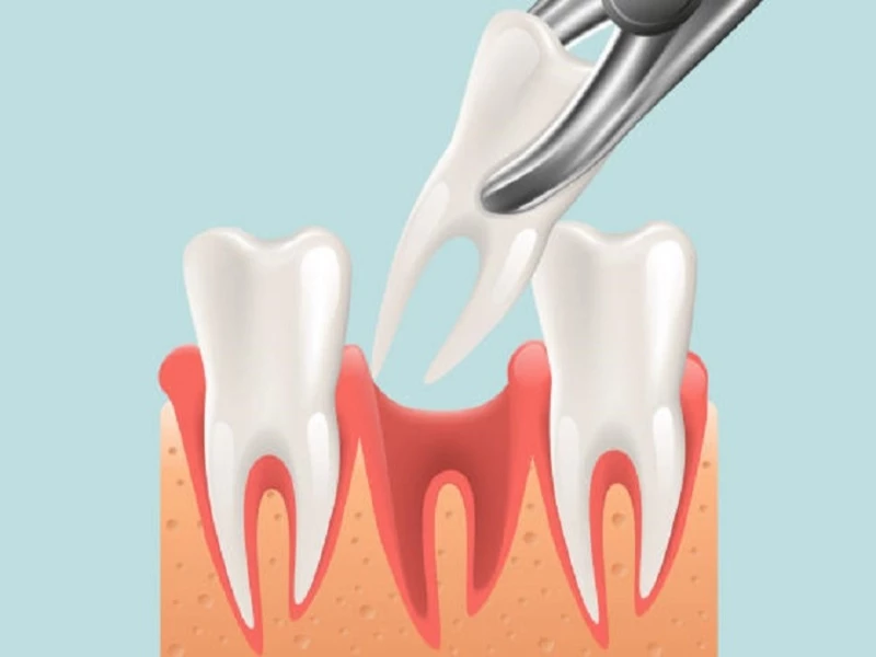 Chỉ định nhổ răng số 7 khi bị vỡ lớn, lung lay nghiêm trọng không thể điều trị bảo tồn 