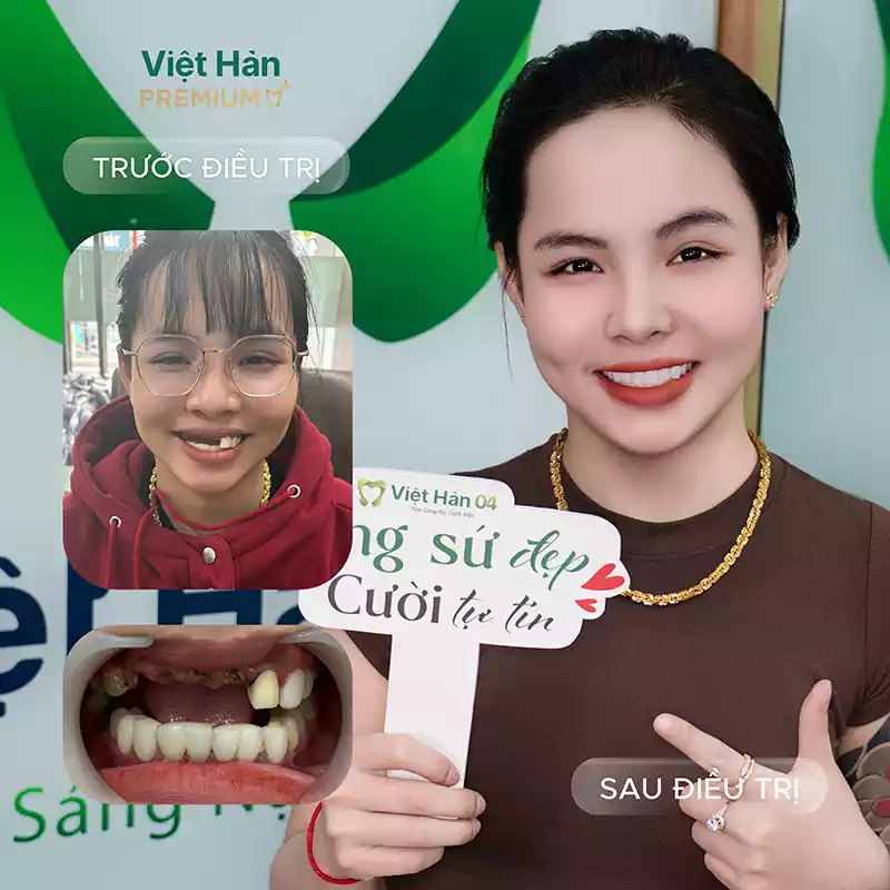 Hình ảnh chị khách làm lại răng sứ hàm trên