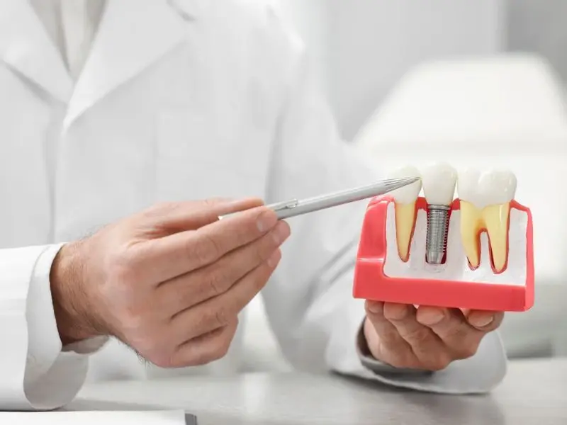 Chọn bác sĩ giỏi quyết định sự thành công của ca cấy ghép Implant