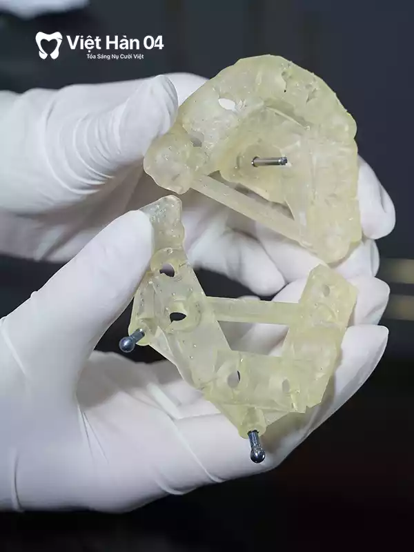 Công nghệ máng định vị phẫu thuật trồng răng toàn hàm