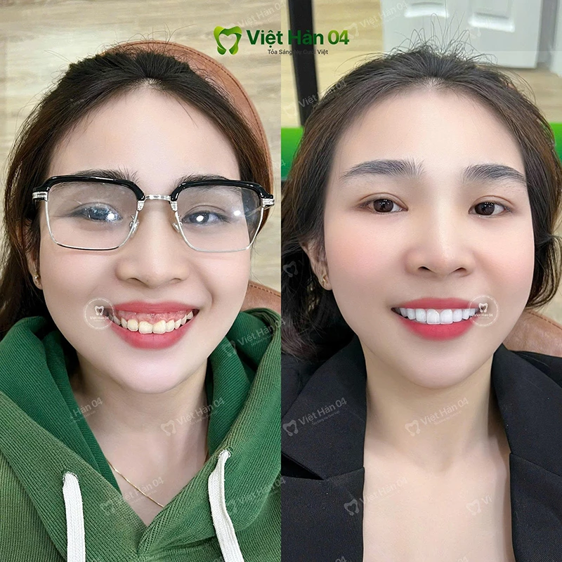 Khách hàng điều trợ cười hở lợi tại Việt Hàn 04