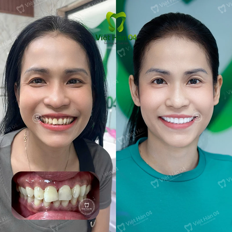 Khách hàng điều trợ cười hở lợi tại Việt Hàn 04