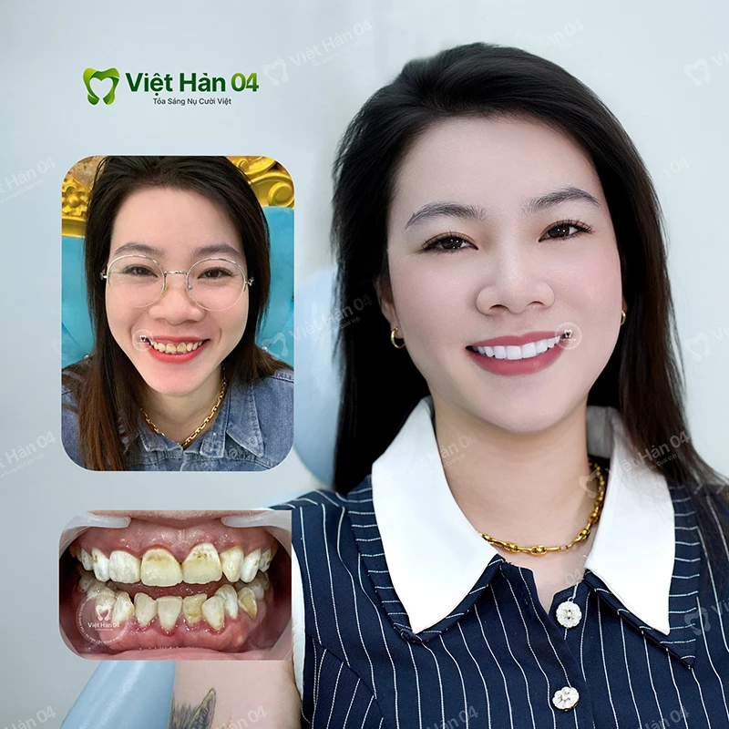 Khách hàng điều trợ cười hở lợi tại Việt Hàn 04
