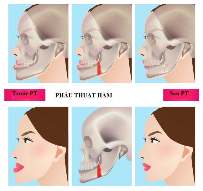 Phẫu thuật xương hàm