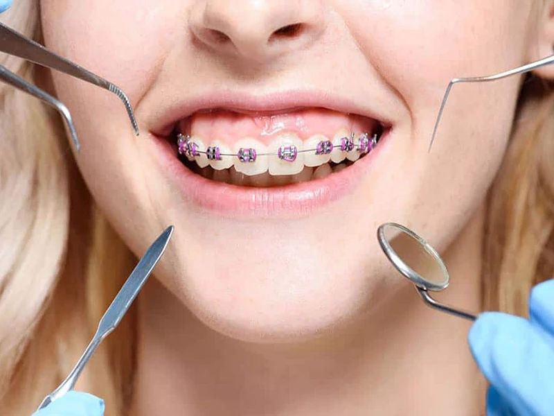 Niềng răng thẩm mỹ