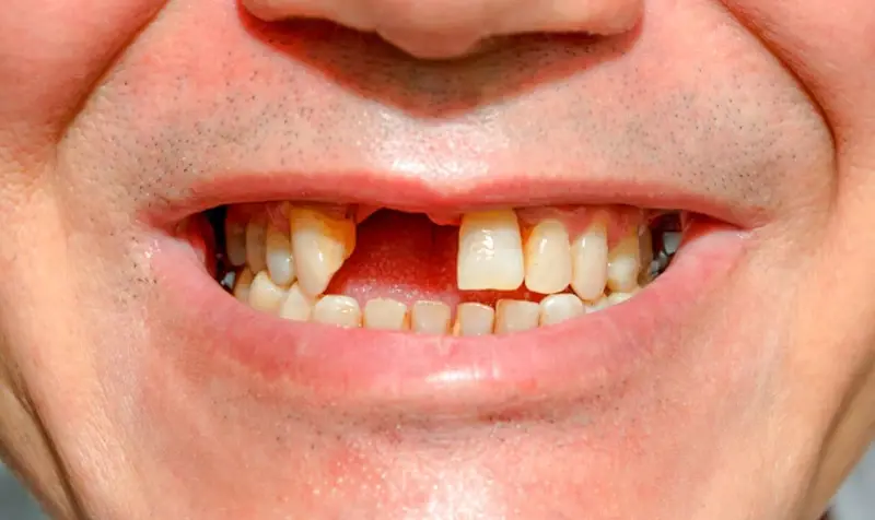 Gãy răng cửa mức độ nặng