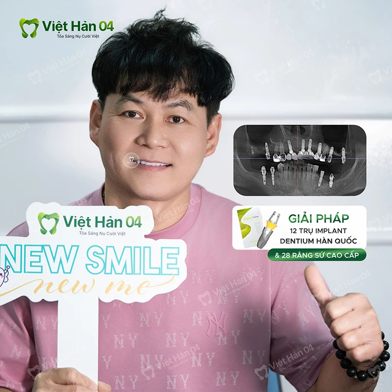 Giải pháp 12 trụ Implant Dentium Hàn Quốc & 28 răng sứ cao cấp
